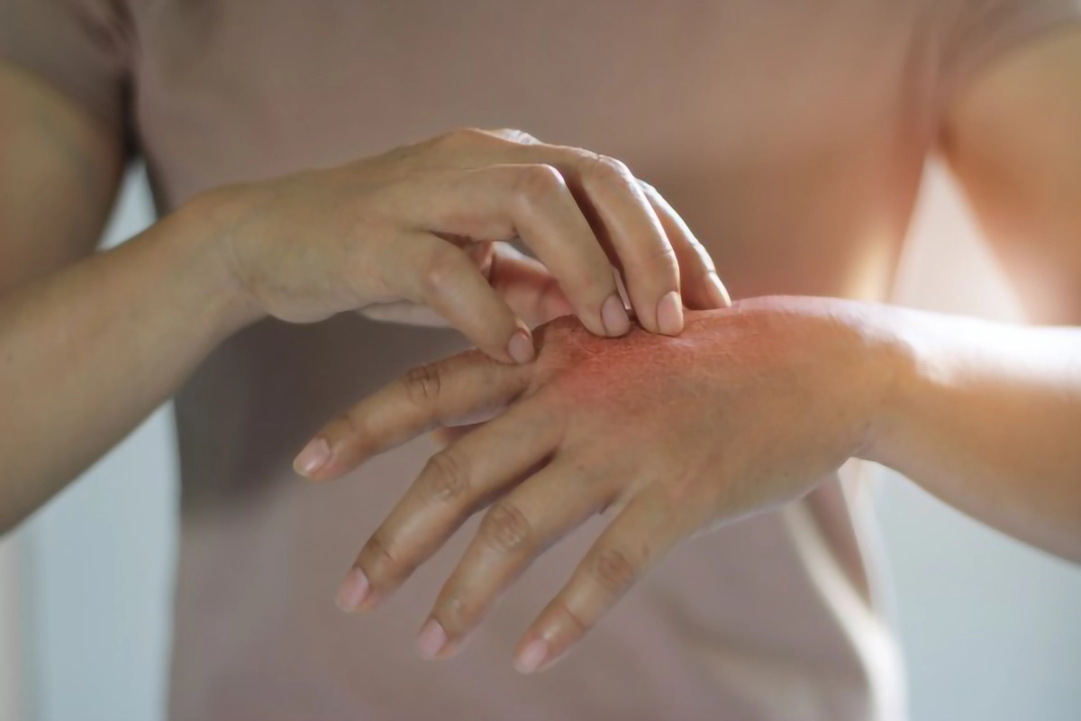 eczma